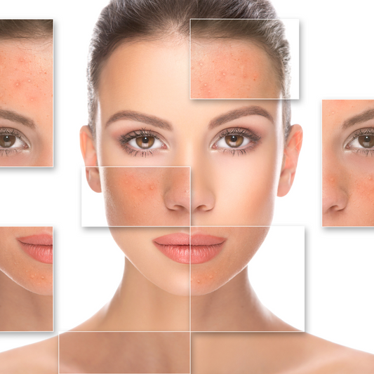 A Guide to Red Light Therapy: Treating Vitiligo, Psoriasis, Scleroderma, and Acne